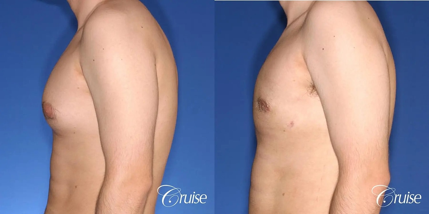 Gynecomastia Surgery Before & After