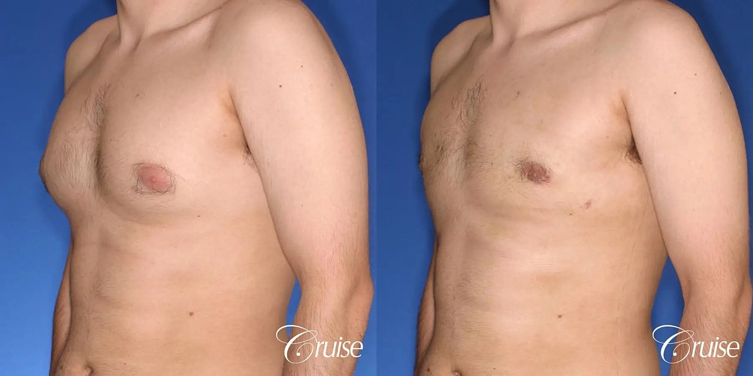 Gynecomastia Surgery Before & After