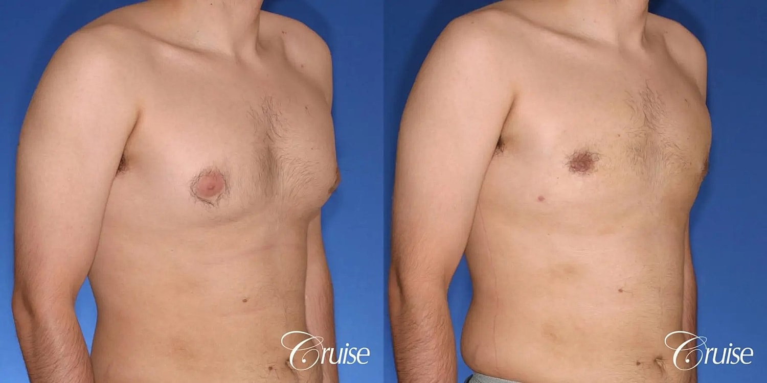 Gynecomastia Surgery Before & After