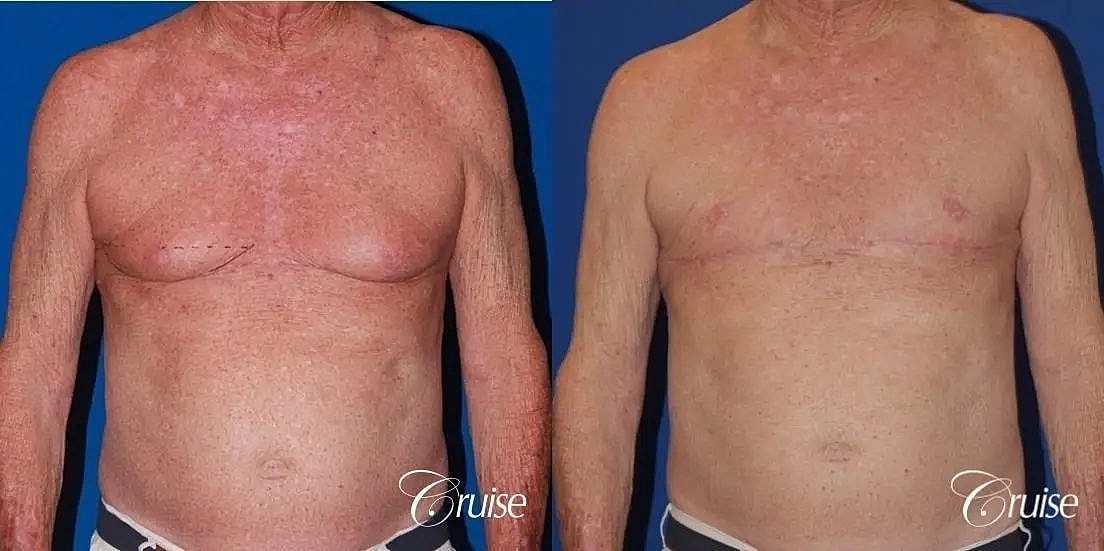 Gynecomastia Surgery Before & After