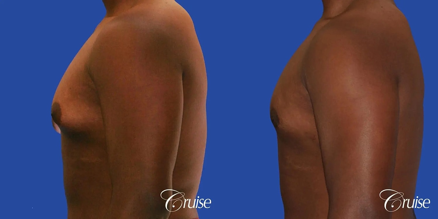 Gynecomastia Surgery Before & After