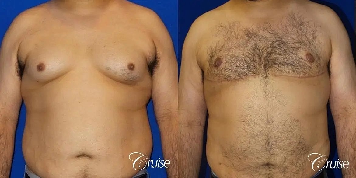 Gynecomastia Surgery Before & After