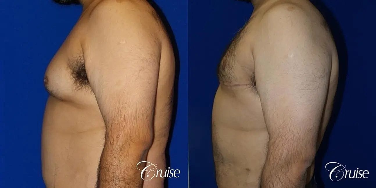 Gynecomastia Surgery Before & After