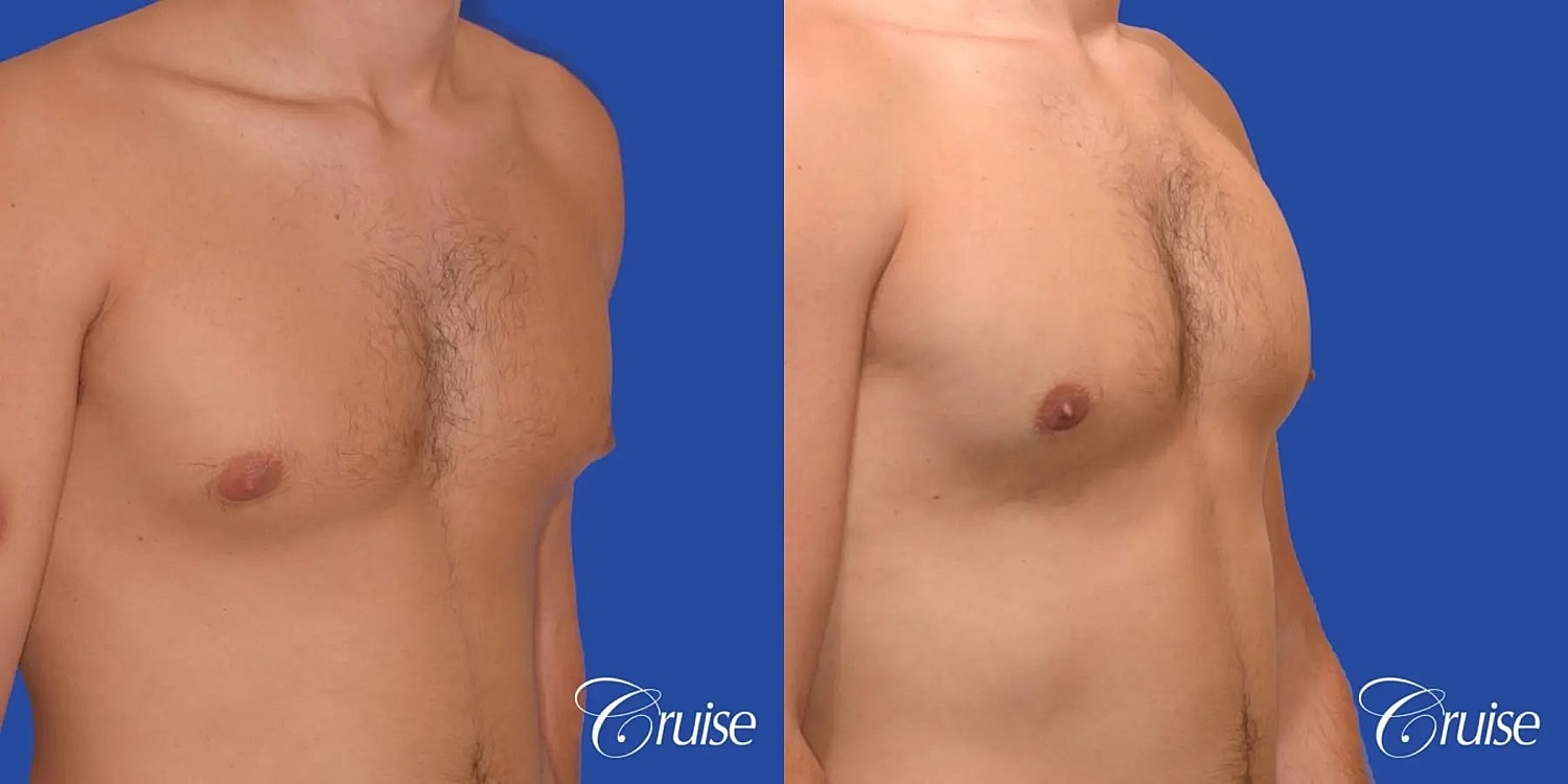 Gynecomastia Surgery Before & After