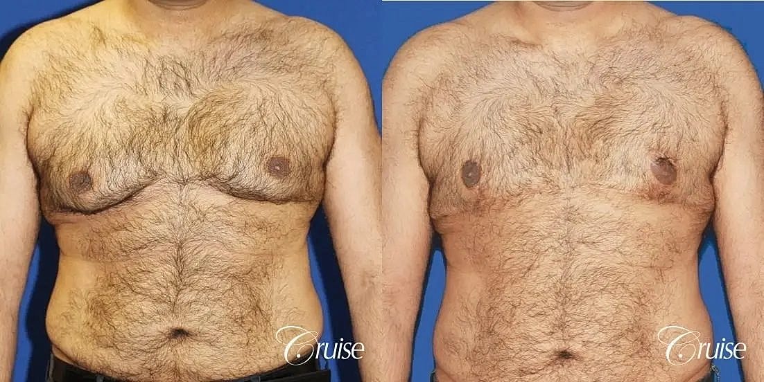 Gynecomastia Surgery Before & After