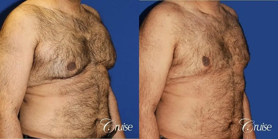 Gynecomastia Surgery Before & After