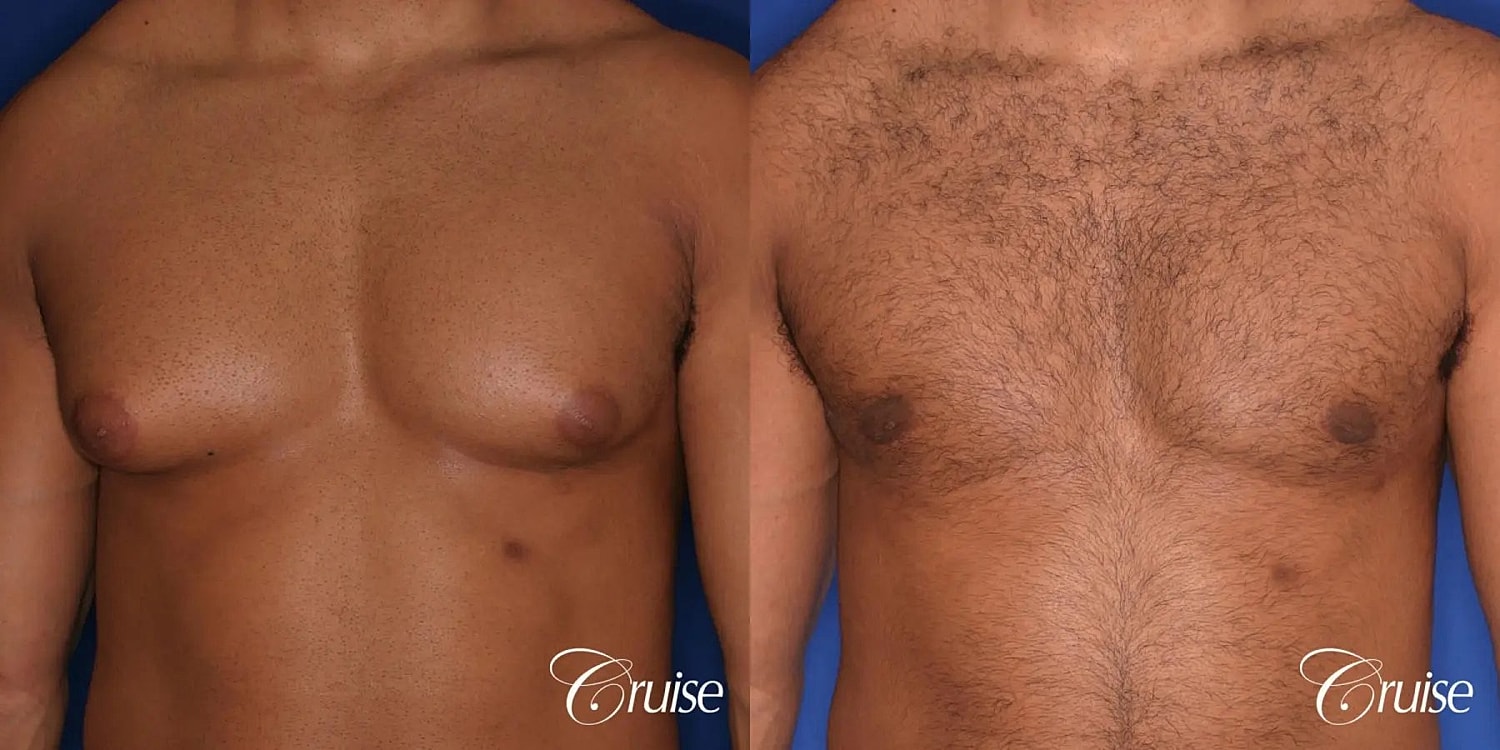 Gynecomastia Surgery Before & After
