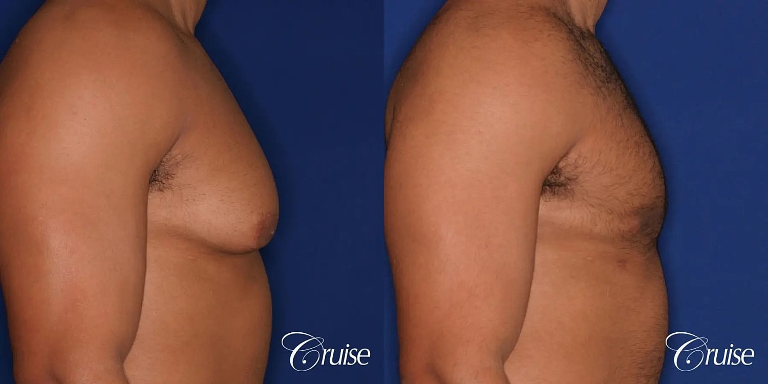 Gynecomastia Surgery Before & After