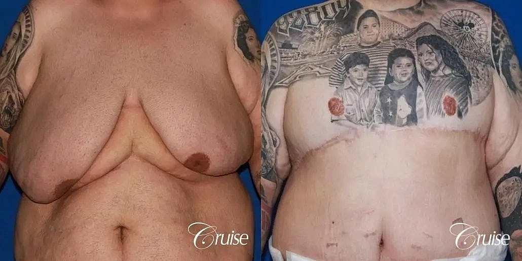 Gynecomastia Surgery Before & After