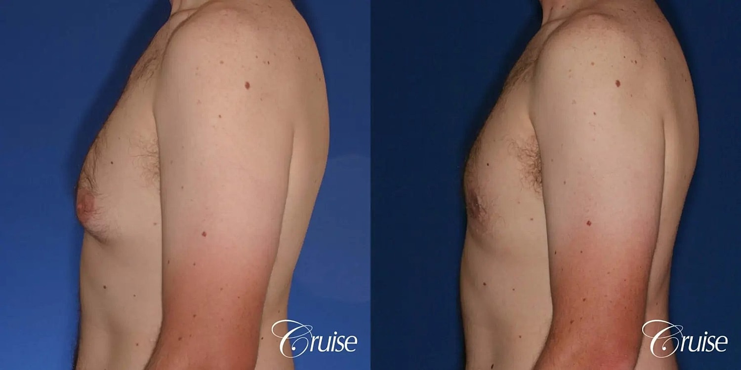 Gynecomastia Surgery Before & After