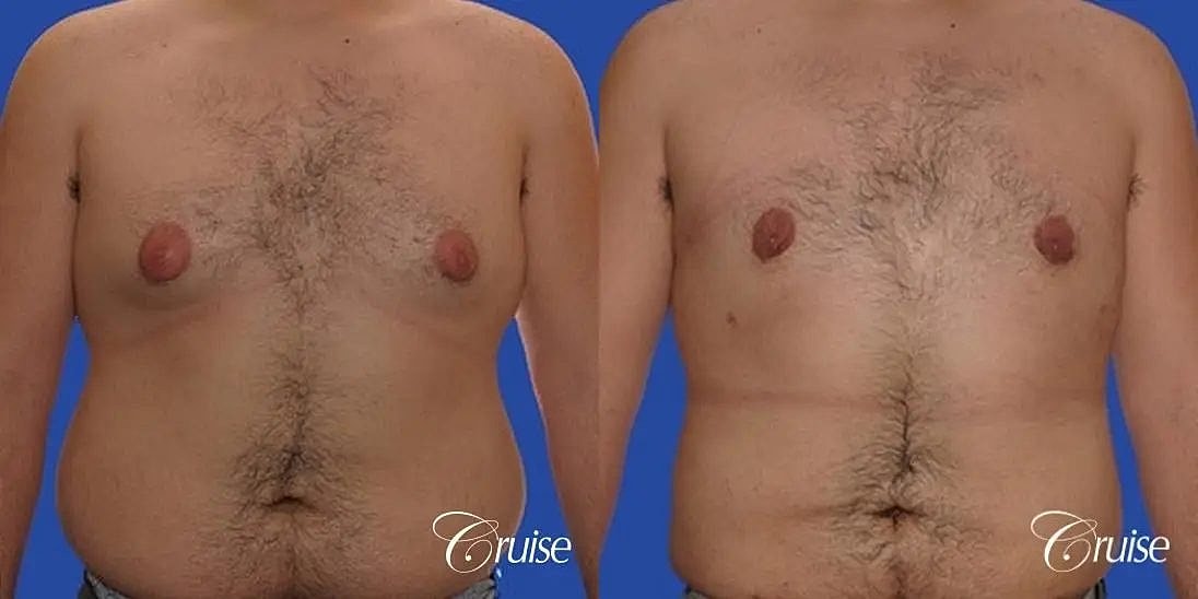 Gynecomastia Surgery Before & After