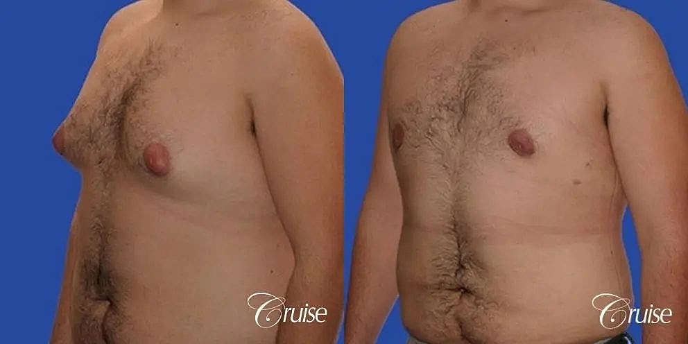 Gynecomastia Surgery Before & After