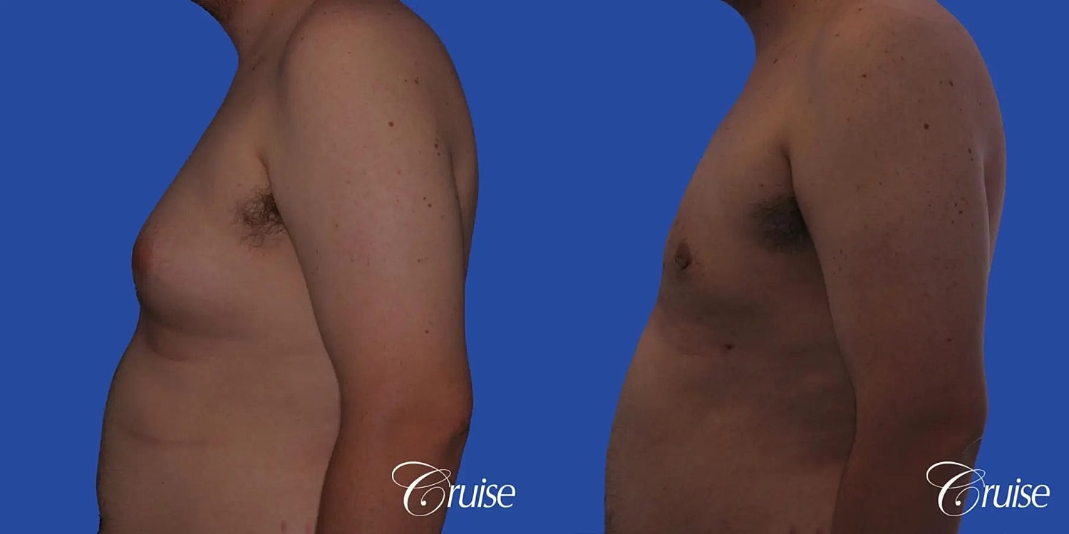 Gynecomastia Surgery Before & After
