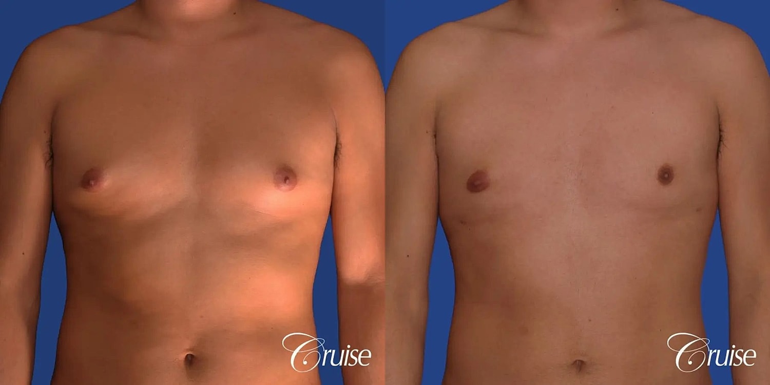 Gynecomastia Surgery Before & After