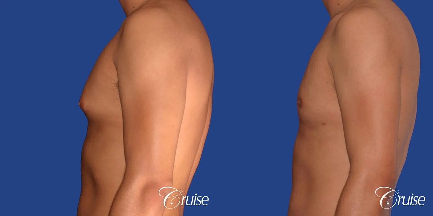 Gynecomastia Surgery Before & After