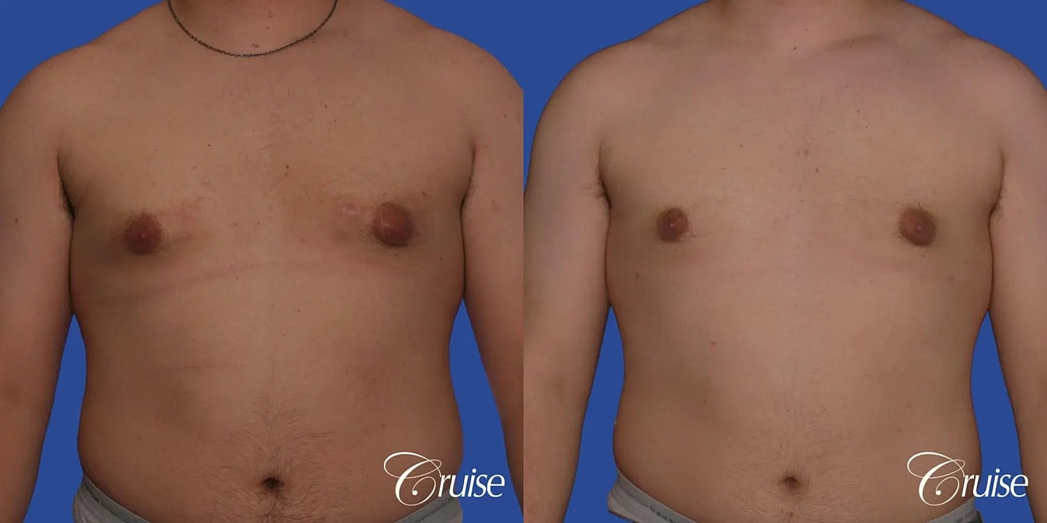 Gynecomastia Surgery Before & After