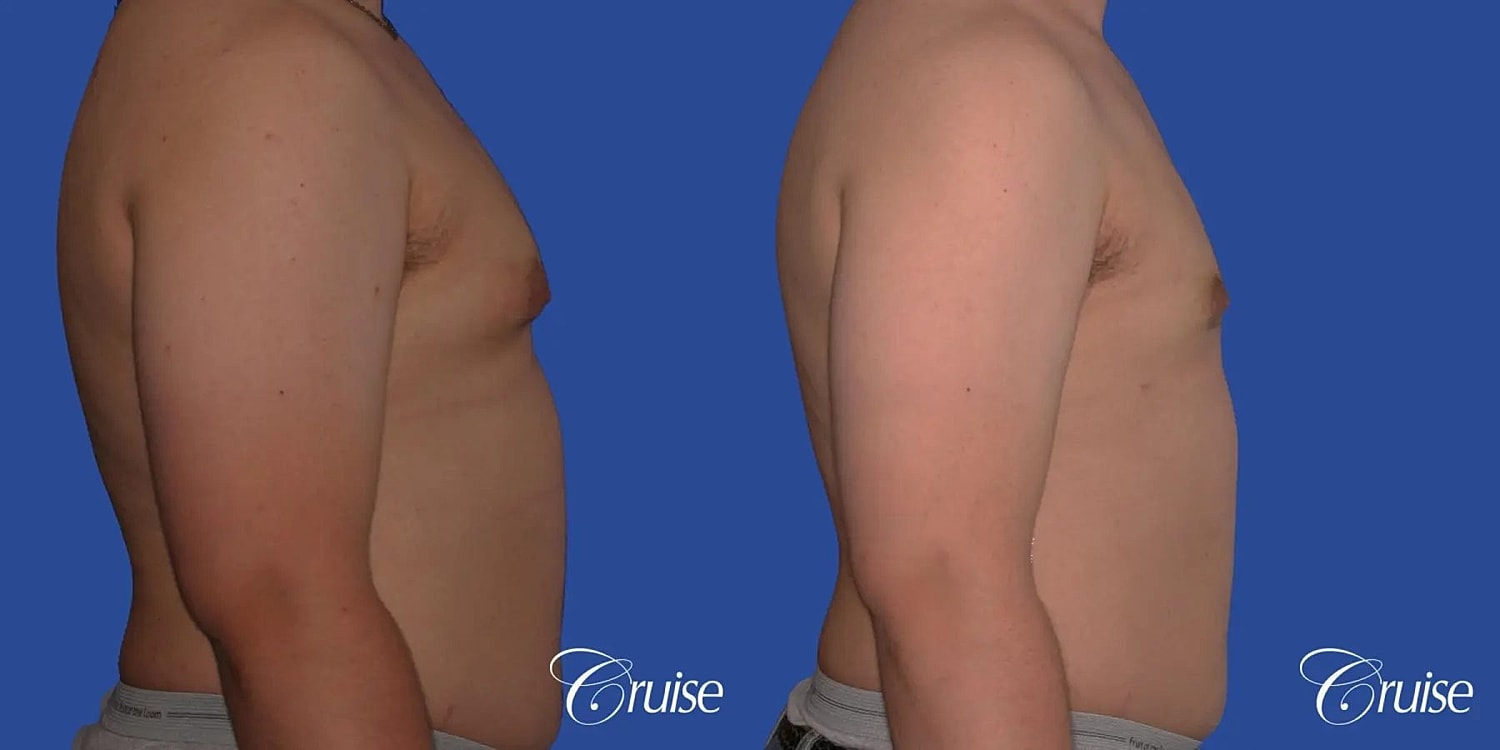 Gynecomastia Surgery Before & After