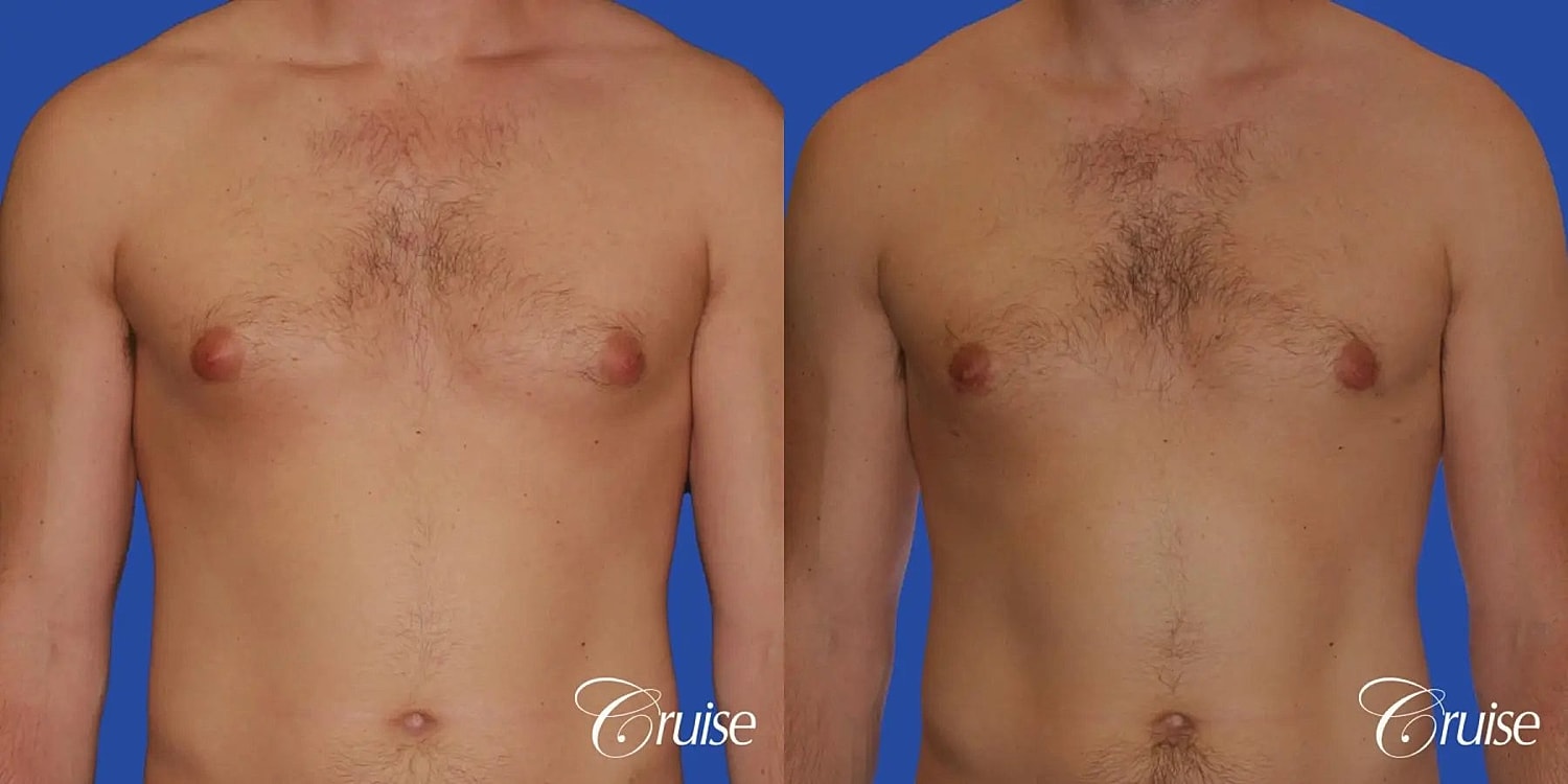 Gynecomastia Surgery Before & After