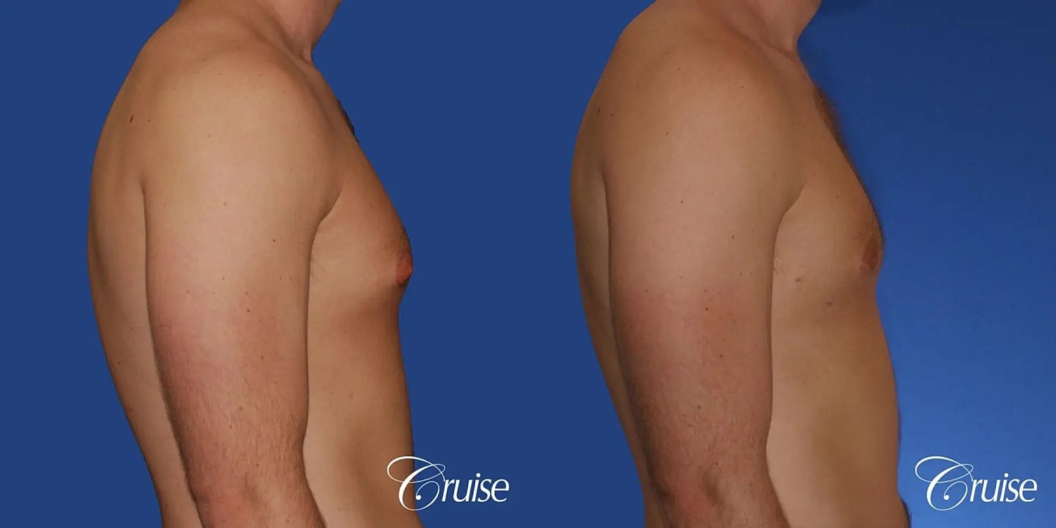 Gynecomastia Surgery Before & After