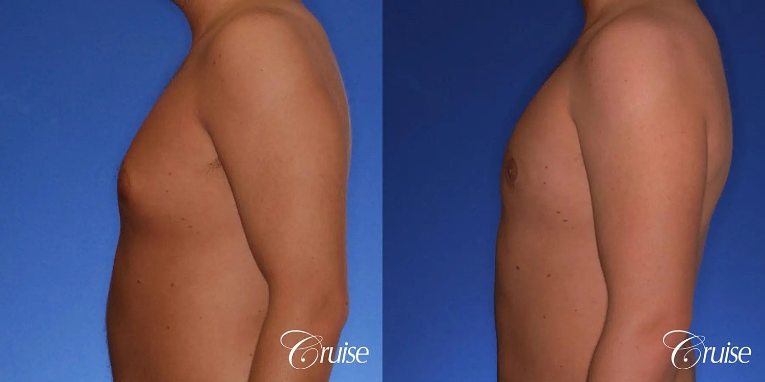 Gynecomastia Surgery Before & After
