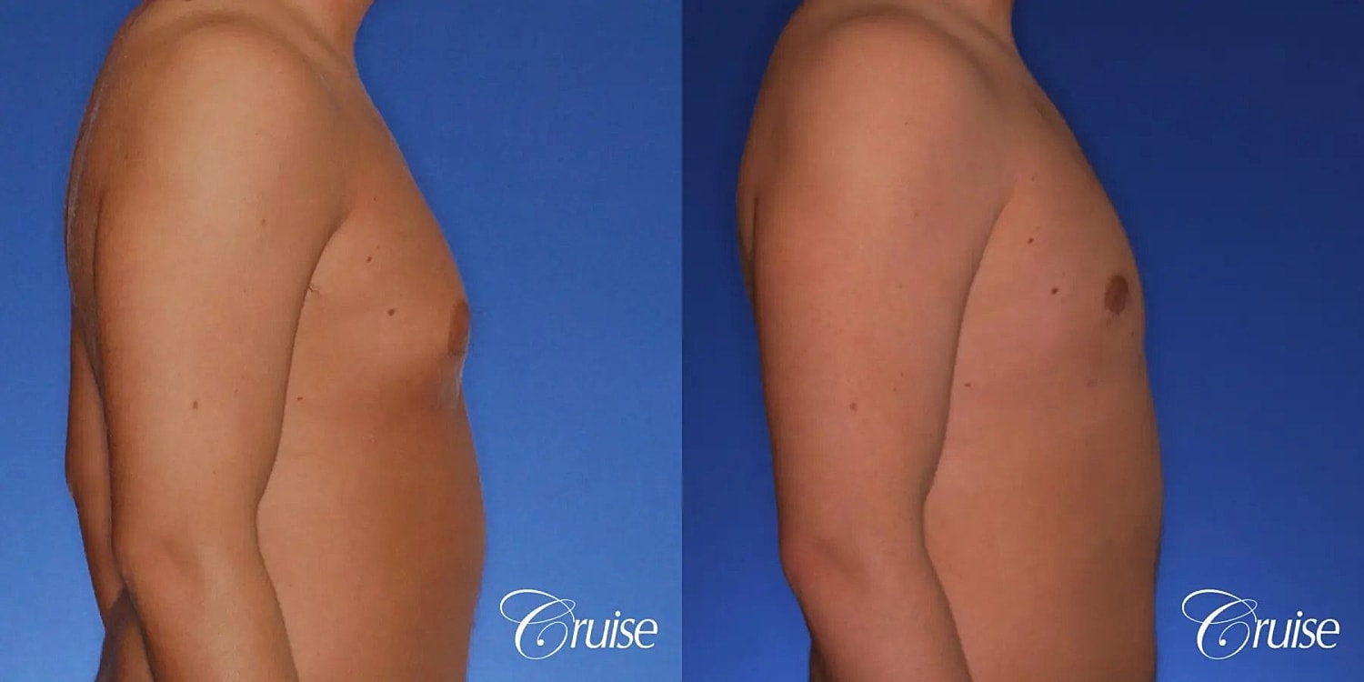 Gynecomastia Surgery Before & After