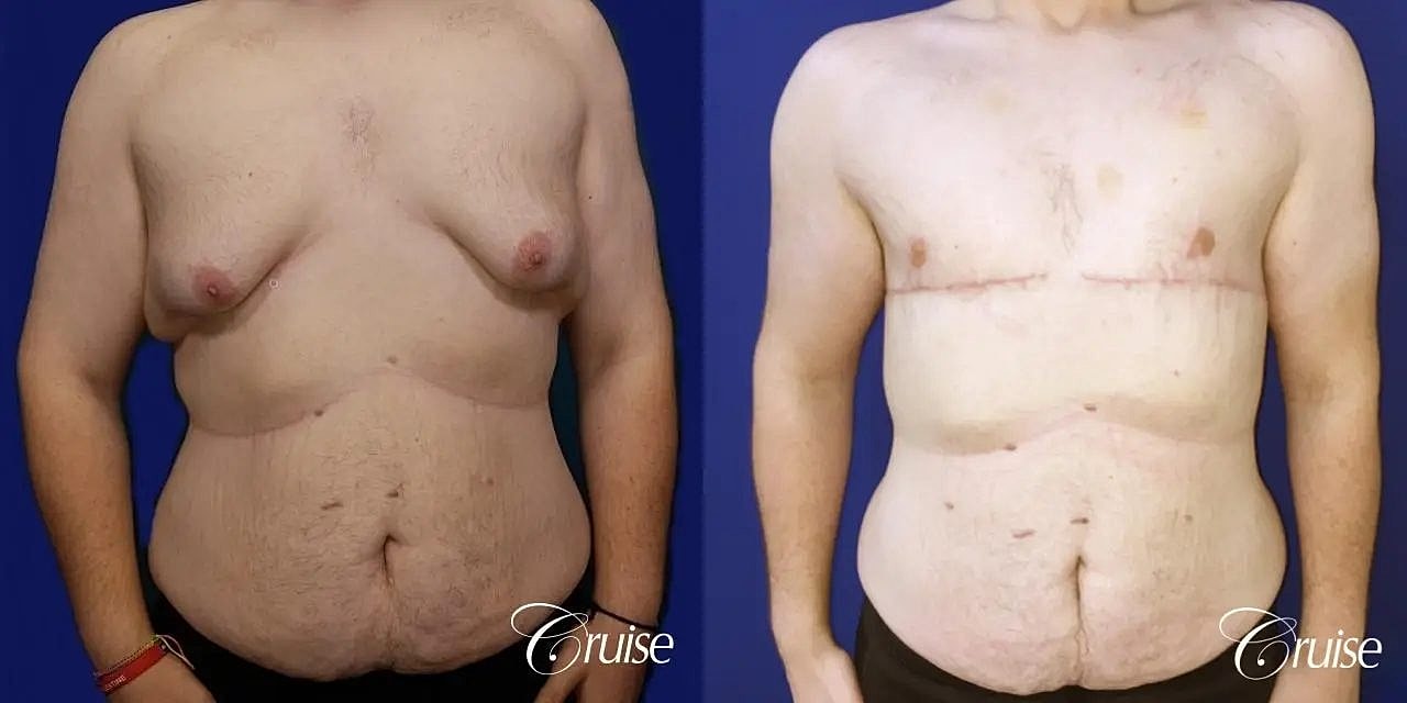 Gynecomastia Surgery Before & After