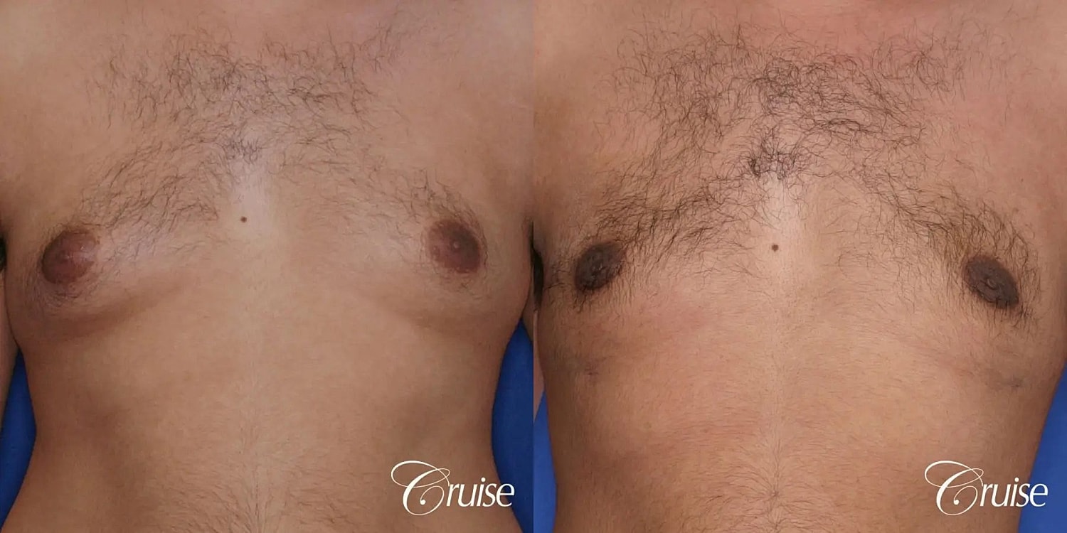 Gynecomastia Surgery Before & After