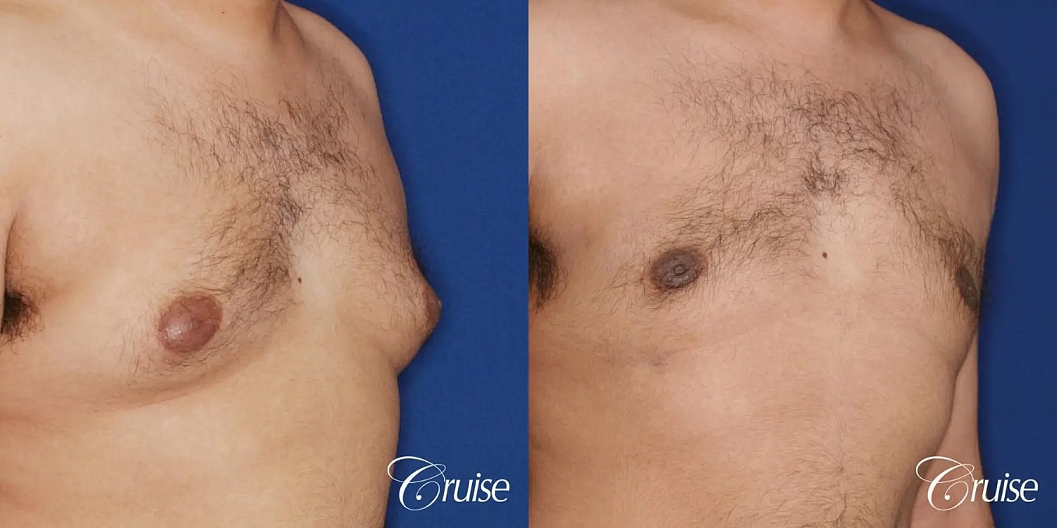 Gynecomastia Surgery Before & After