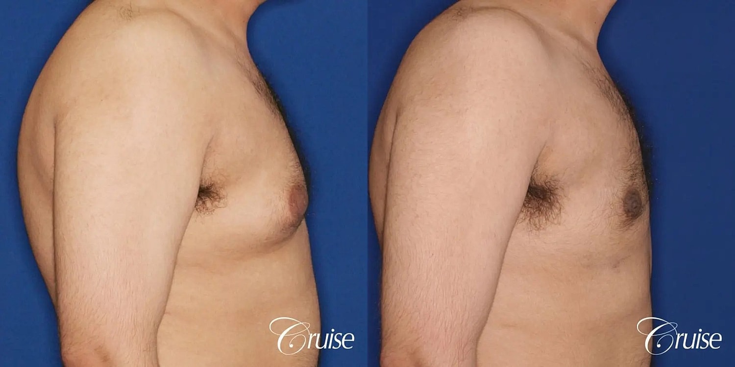 Gynecomastia Surgery Before & After