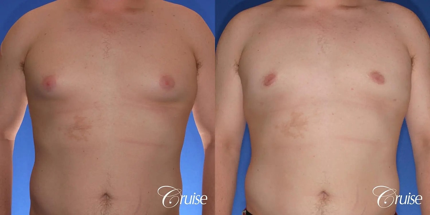 Gynecomastia Surgery Before & After