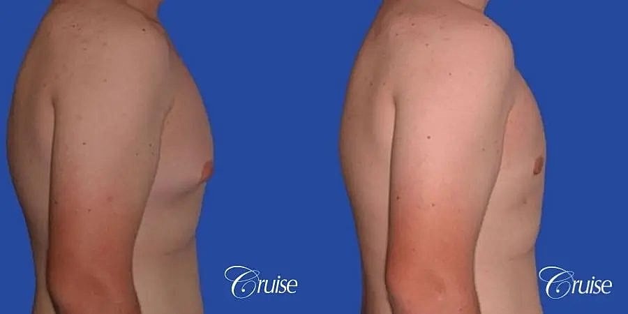Gynecomastia Surgery Before & After