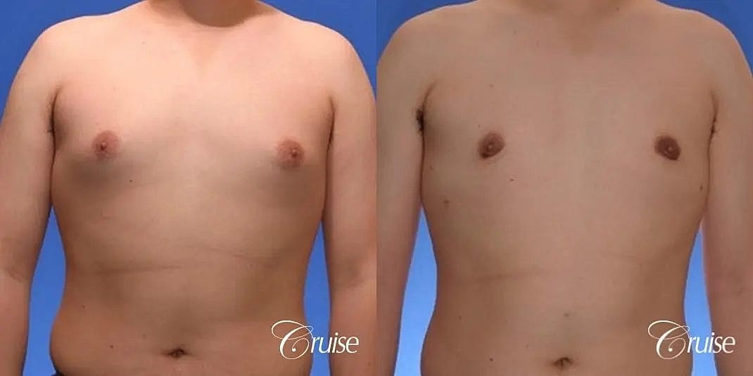 Gynecomastia Surgery Before & After