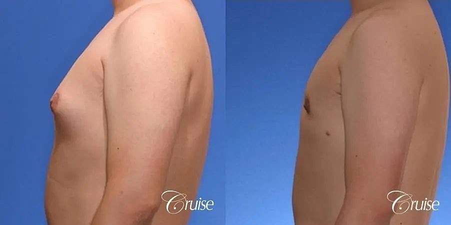 Gynecomastia Surgery Before & After
