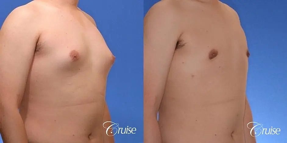 Gynecomastia Surgery Before & After