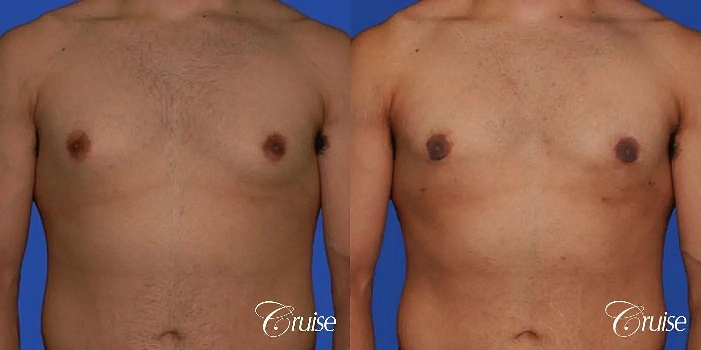 Gynecomastia Surgery Before & After
