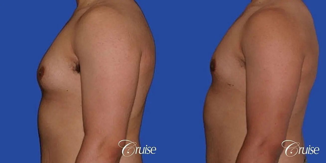 Gynecomastia Surgery Before & After