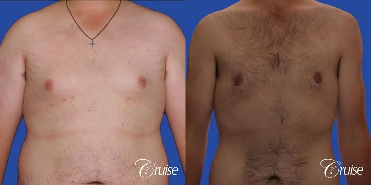 Gynecomastia Surgery Before & After