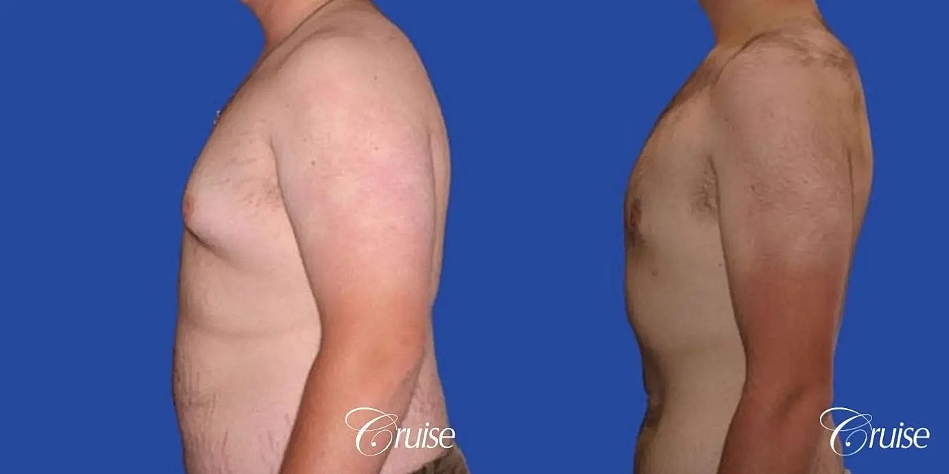 Gynecomastia Surgery Before & After