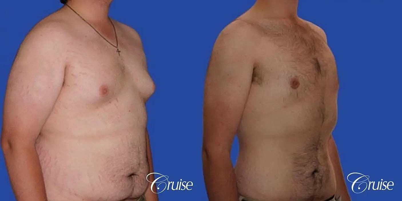 Gynecomastia Surgery Before & After