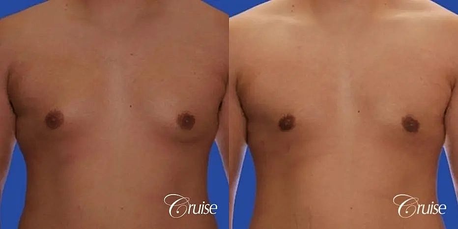 Gynecomastia Surgery Before & After