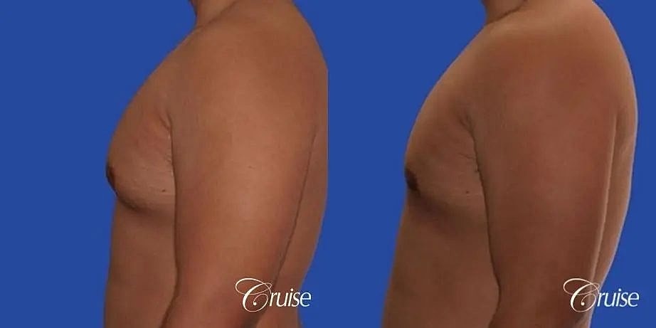 Gynecomastia Surgery Before & After