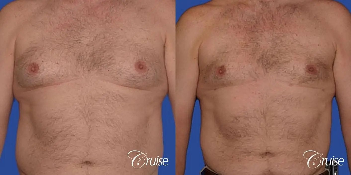 Gynecomastia Surgery Before & After