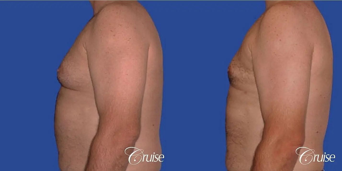 Gynecomastia Surgery Before & After
