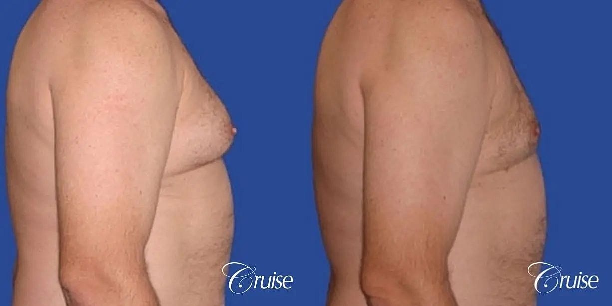 Gynecomastia Surgery Before & After