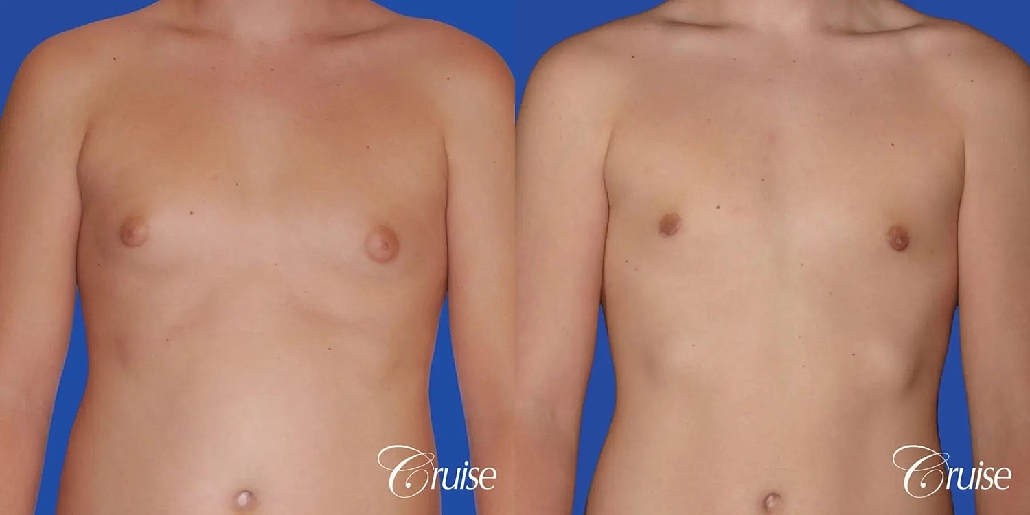 Gynecomastia Surgery Before & After