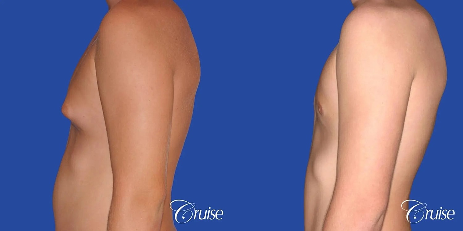 Gynecomastia Surgery Before & After