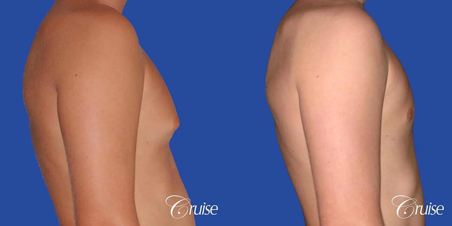 Gynecomastia Surgery Before & After
