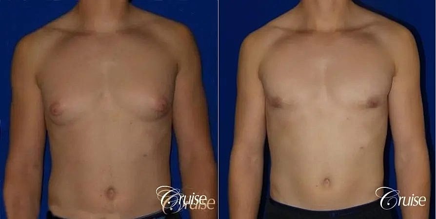 Gynecomastia Surgery Before & After
