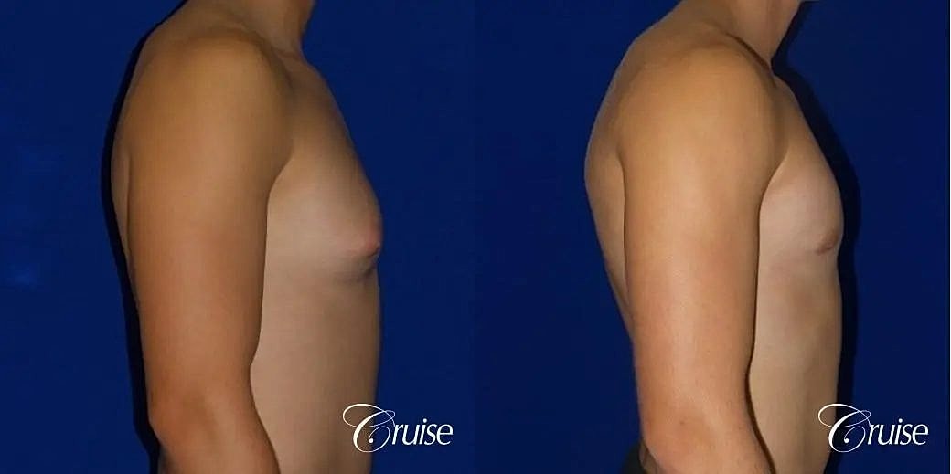 Gynecomastia Surgery Before & After