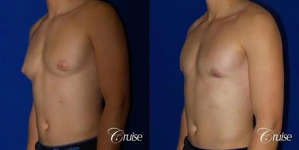 Gynecomastia Surgery Before & After
